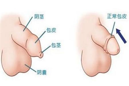 不治疗包皮包茎的危害