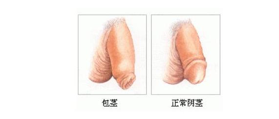 生活中怎么预防包皮包茎