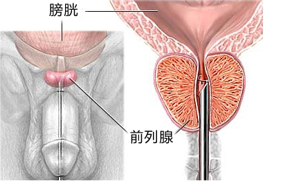 前列腺炎对身体的危害