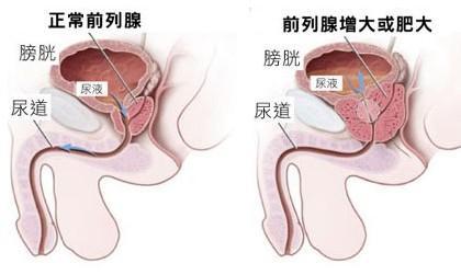 详解前列腺炎的危害