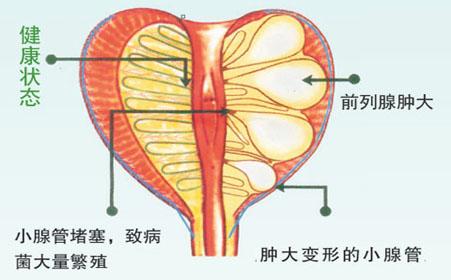 前列腺囊肿病因分类