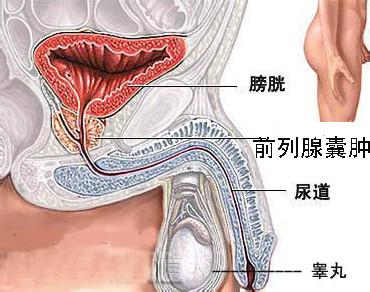 前列腺囊肿最基本的病因